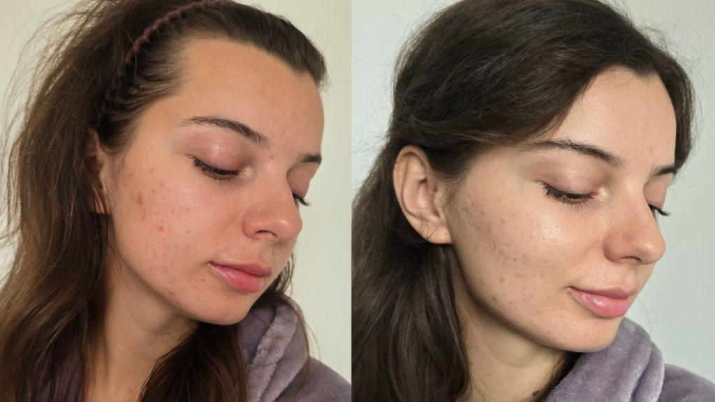The Hormonal Link to Clear Skin: Understanding Anti-Androgen Therapy for Acne and Hirsutism
